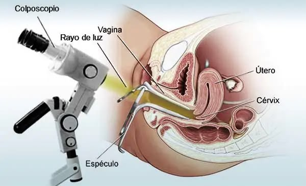 Diagrama explicativo de la colposcopia